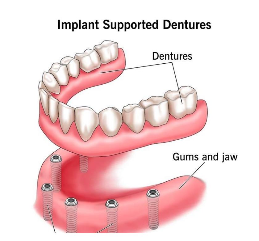 Implant supported dentures